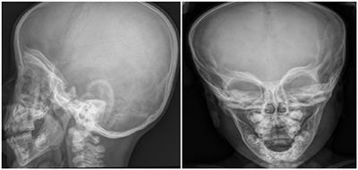 Carbonic Anhydrase II Deficiency: A Rare Case of Severe Obstructive Sleep Apnea